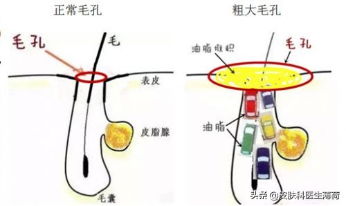 医生建议收缩毛孔的最好方法,医生清理毛孔