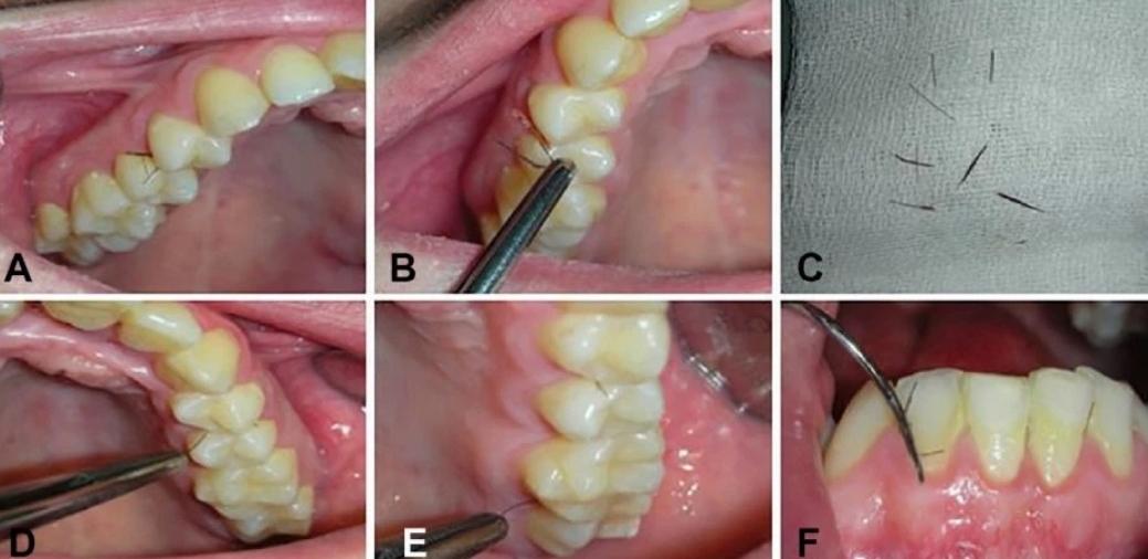 意大利女子牙龈长出睫毛状毛发,历经8年未治愈,病因很常见