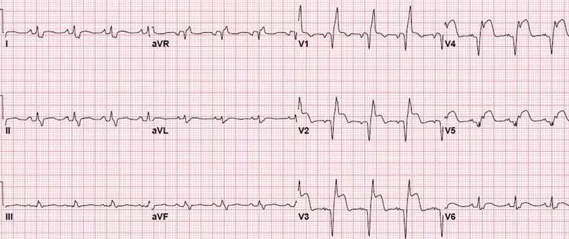常见心梗特殊心电图,各部位心梗心电图详解