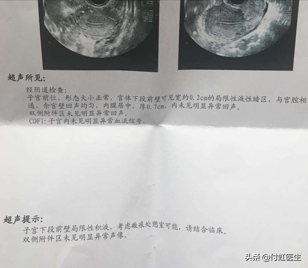 剖宫产后2年B超发现子宫里面出了“套间”,影响我要二宝吗?