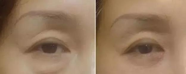 如何去眼袋拥有卧蚕,眼袋卧蚕和泪沟区别