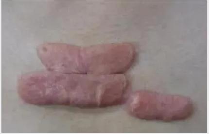 恩泽医院治疗疤痕疙瘩,国际医学中心治疗疤痕疙瘩怎么样