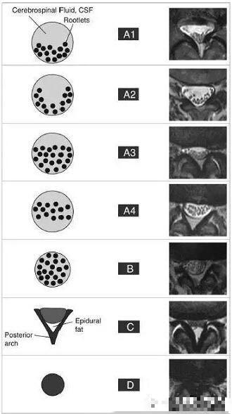 腰痛痛到走路一瘸一拐？你需要了解一下“微创减压手术”