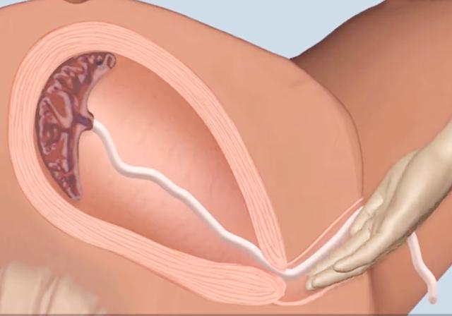 扛过剖腹产的痛,扛过了分娩之痛