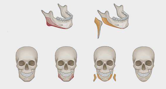 磨骨手术属于几级手术,揭秘神秘的手术室