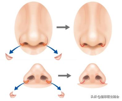 鼻翼缩小外切好吗,鼻翼缩小外切还是内切效果好