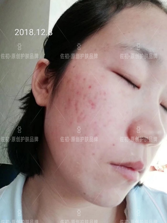 生完孩子烂脸,生完孩子脸上垮了怎样处理