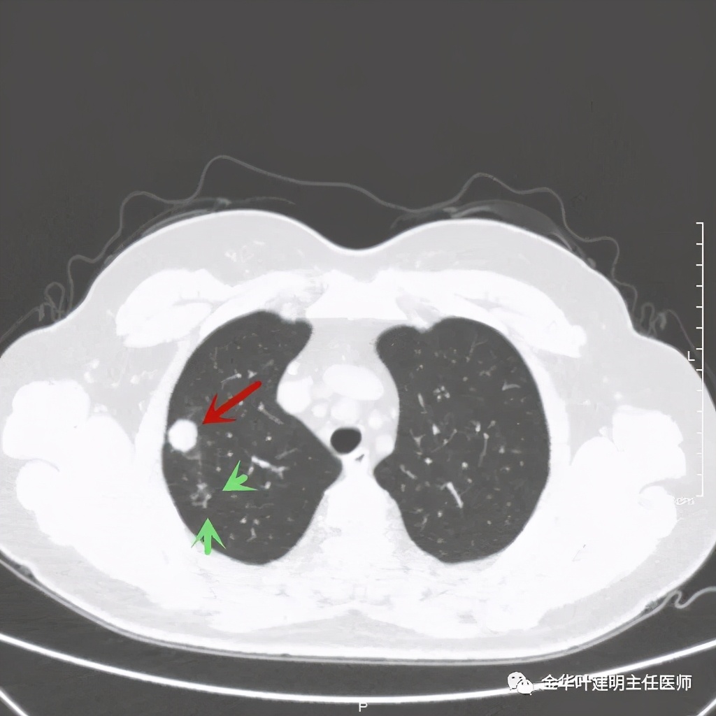 右上肺结节灶一般是什么癌,右上肺恶性肿瘤是肺癌吗