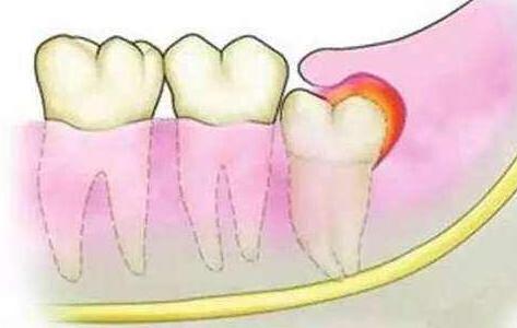 所有人拔智齿都会肿吗,智齿拔了以后智齿还有什么用