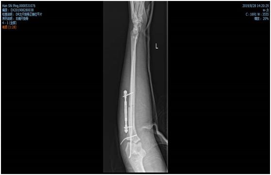 骨折一定要打石膏吗,骨折非要打钢钉吗