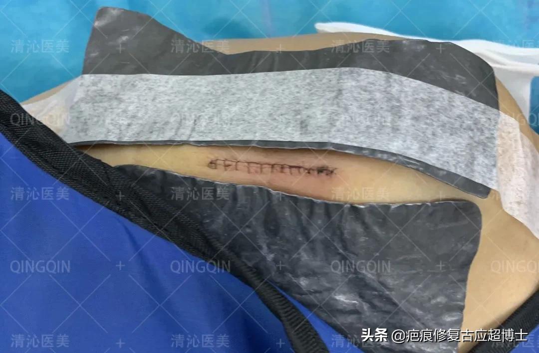 背部瘢痕疙瘩怎么去除,肩膀瘢痕疙瘩怎么食疗