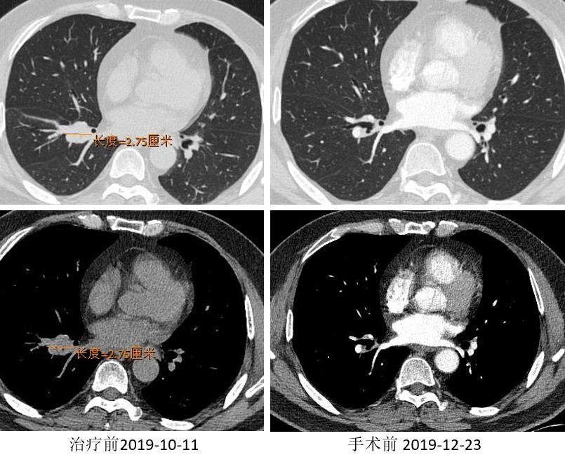 PD-1新辅助治疗初探，典型案例汇总一览