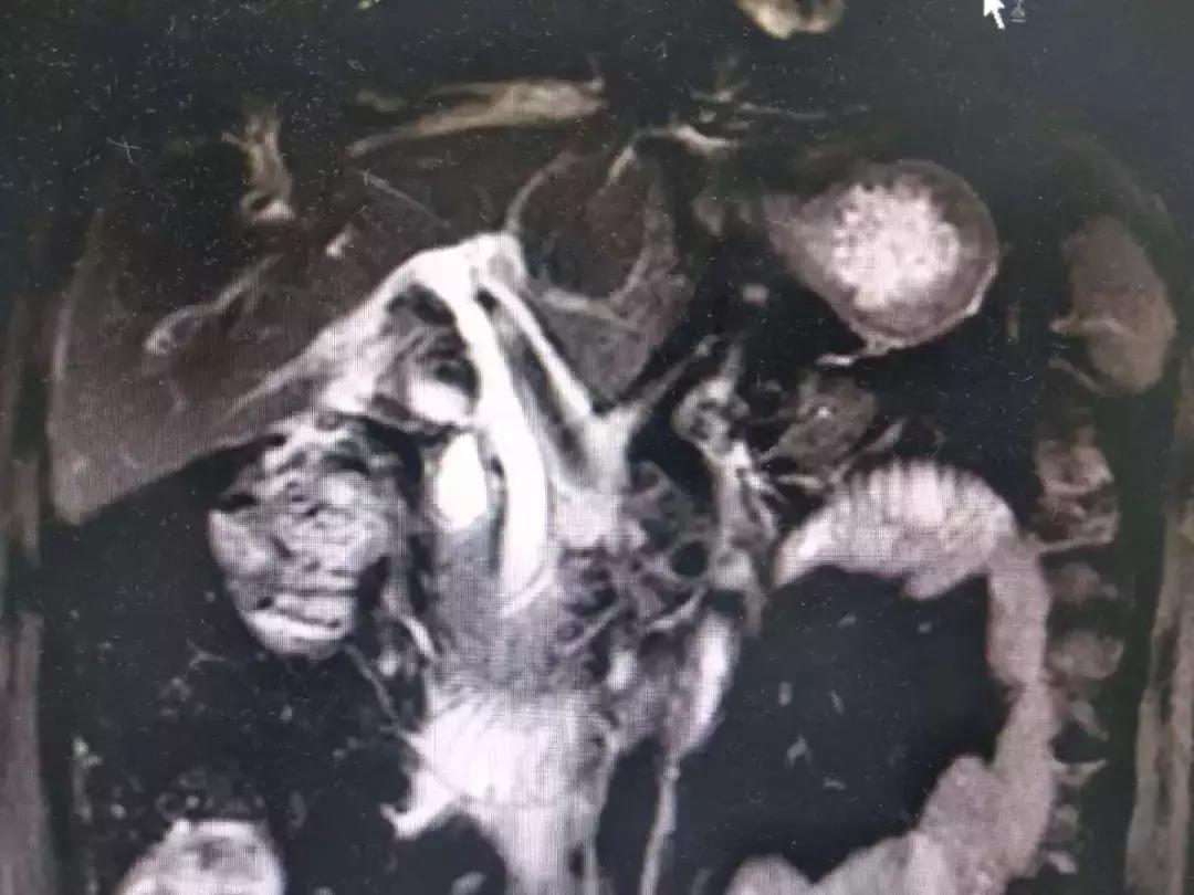 诊断梗阻性黄疸最有效的检查方法,梗阻性黄疸哪种引流方法好