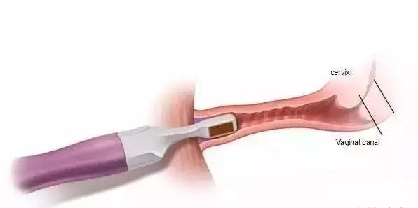 产后的你有没有漏尿的情况,产后漏尿又紧致最快恢复办法