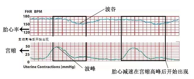 怎么能顺利快速通过胎心监护,怎么使胎心监护快速过关