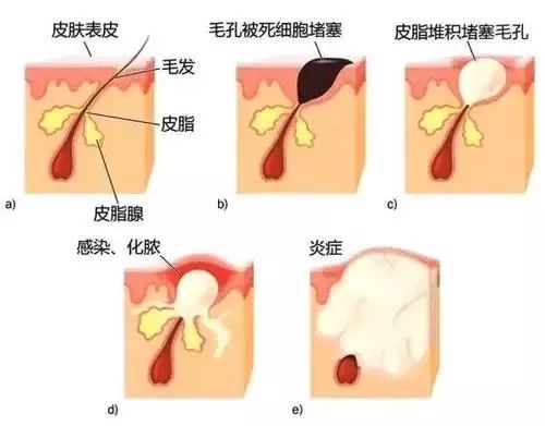 该怎样从源头上改善成人痘印痘坑,祛红痘印黑痘印医美