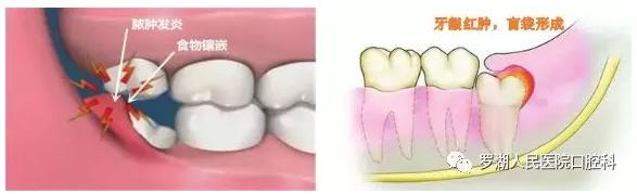 不想拔智齿但很疼怎么办,不想拔智齿想磨掉一部分怎么样
