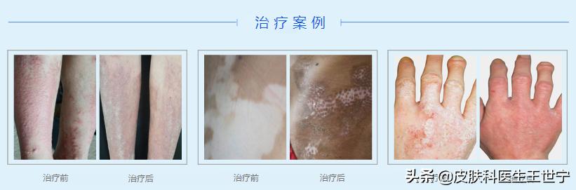 白癜风遮盖神器哪个好,白癜风去除神器