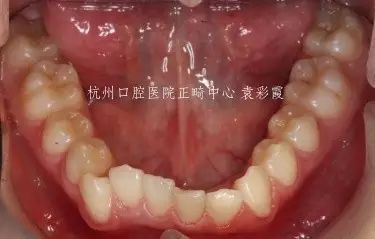 牙齿深覆合对脸型的影响,覆合型牙齿是怎么造成的