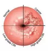 宫颈重度糜烂要做leep刀吗,重度宫颈糜烂必须要做leep刀吗