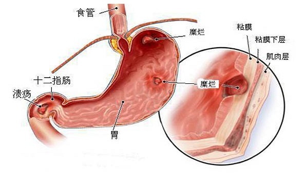 如何去除胃中的幽门螺杆菌,每天都清理好口腔的好处