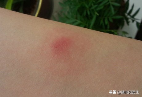 打破伤风抗毒素过敏怎么办,猪用破伤风抗毒素过敏咋治