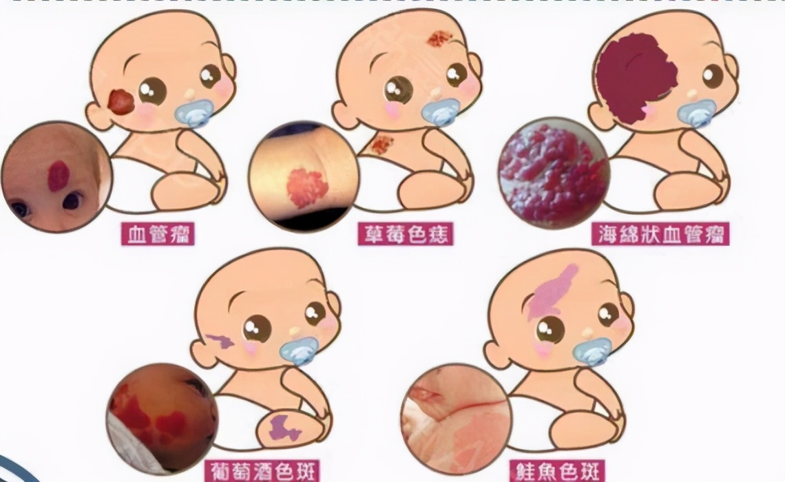 上帝吻过的脸胎记,上帝的吻痕