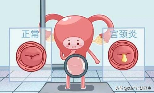 宫颈炎靠吃药能好吗,宫颈炎癌变的症状能治愈吗