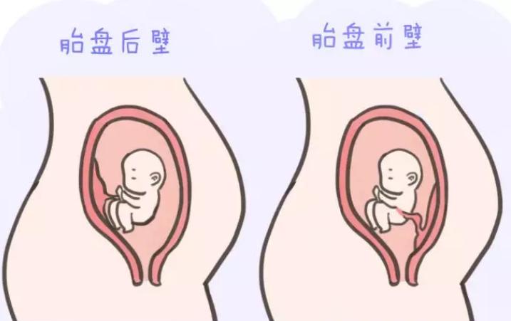 前壁胎盘需要注意事项,前壁胎盘需要注意什么
