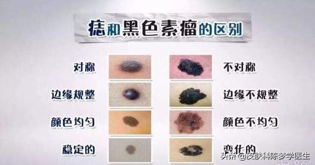 激光点痣为啥痣大了,颠覆你认知的祛斑方式