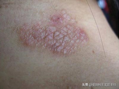 神经性皮炎病程,神经性耳鸣和神经性皮炎病因