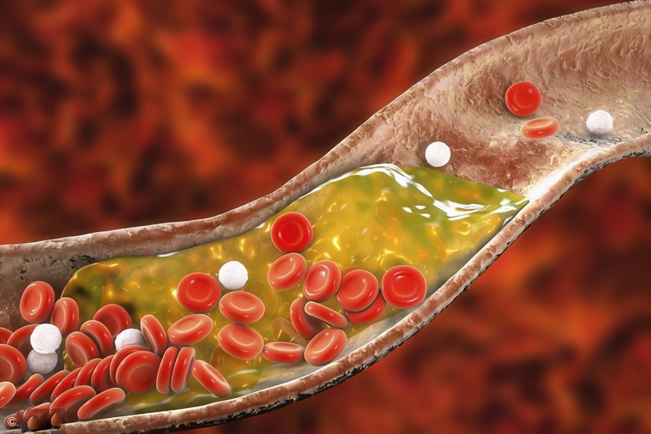 血脂升高了吃什么药,血脂偏高需要降脂药吗