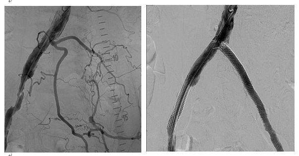 老年人腿疼怎么判断是骨质疏松,老年人腿脚无力是什么病