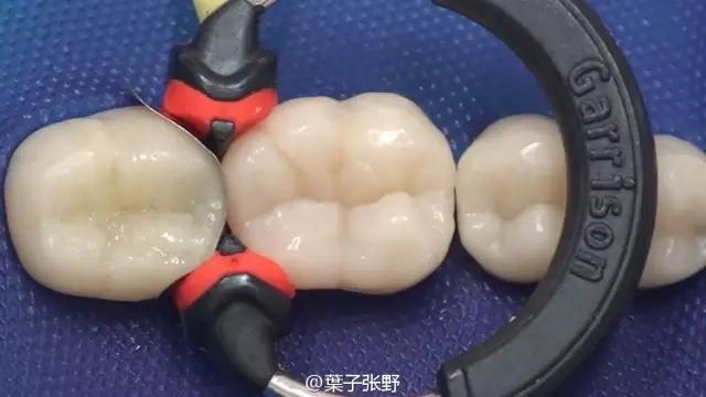 补牙疼吗补牙过程图,补牙全部过程是什么样子的