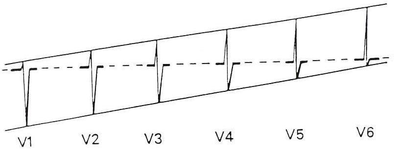 心电图诊断口诀图解,判读心电图的正确方法