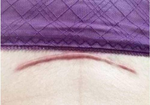 剖腹产一年半以后阴雨天刀口痒,剖腹产刀口6个月还红痒正常吗