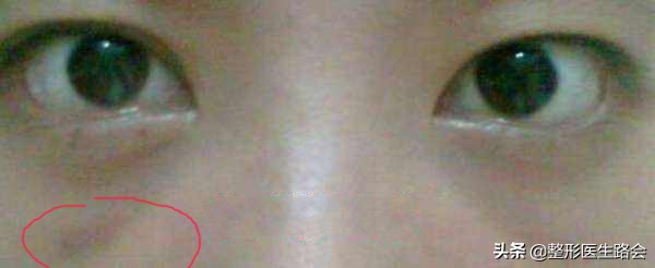 填了泪沟眼睛淤青很厉害,填完泪沟8个月了还淤青怎么办