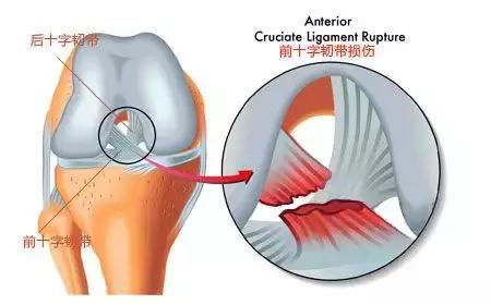 20多岁喜欢运动的你，要警惕膝关节反复扭伤
