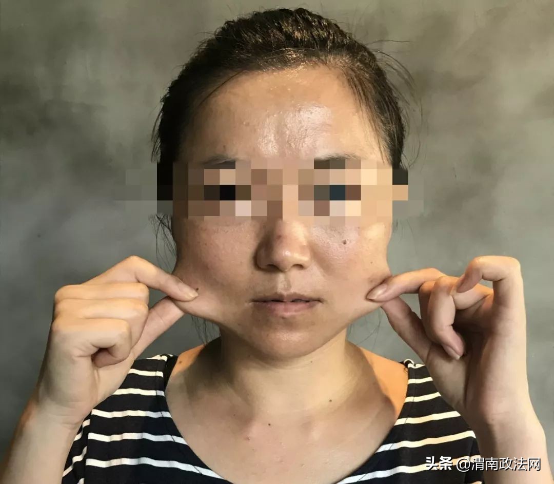 瘦脸针毁容了,打瘦脸针毁容引起红肿眼睛看不见