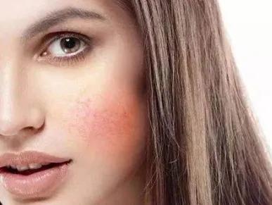 过敏脸上起红疙瘩,春敏脸上泛红发痒原因