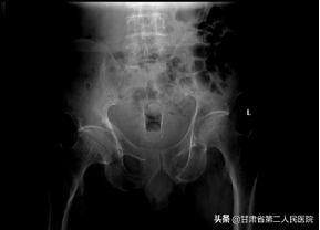 首例！甘肃省二院消化科置入结肠覆膜金属支架治疗术后肠道狭窄