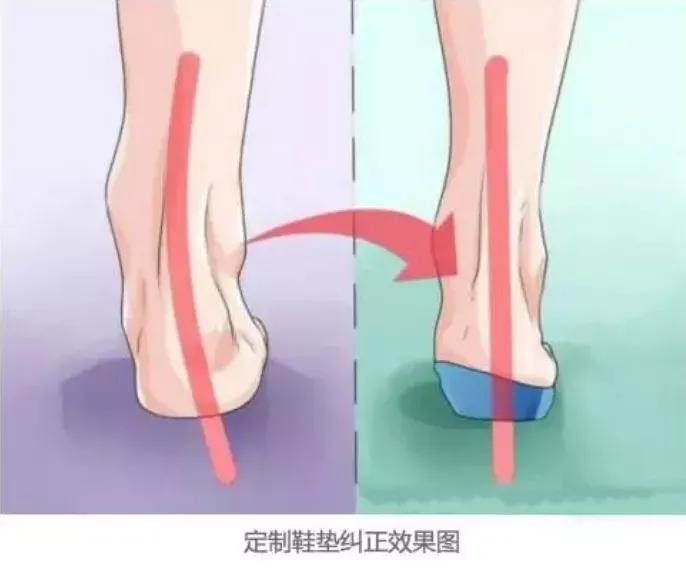 如何判断扁平足是先天还是后天,扁平足简单自测