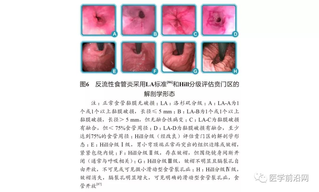 胃食管反流引起的哮喘咳嗽严重吗,胃食管反流性咽喉炎及反流性哮喘