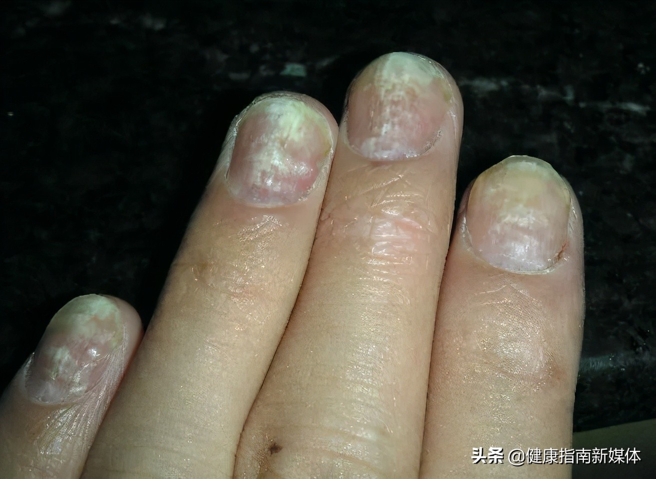 脚灰指甲的危害,灰指甲做饭有危害吗