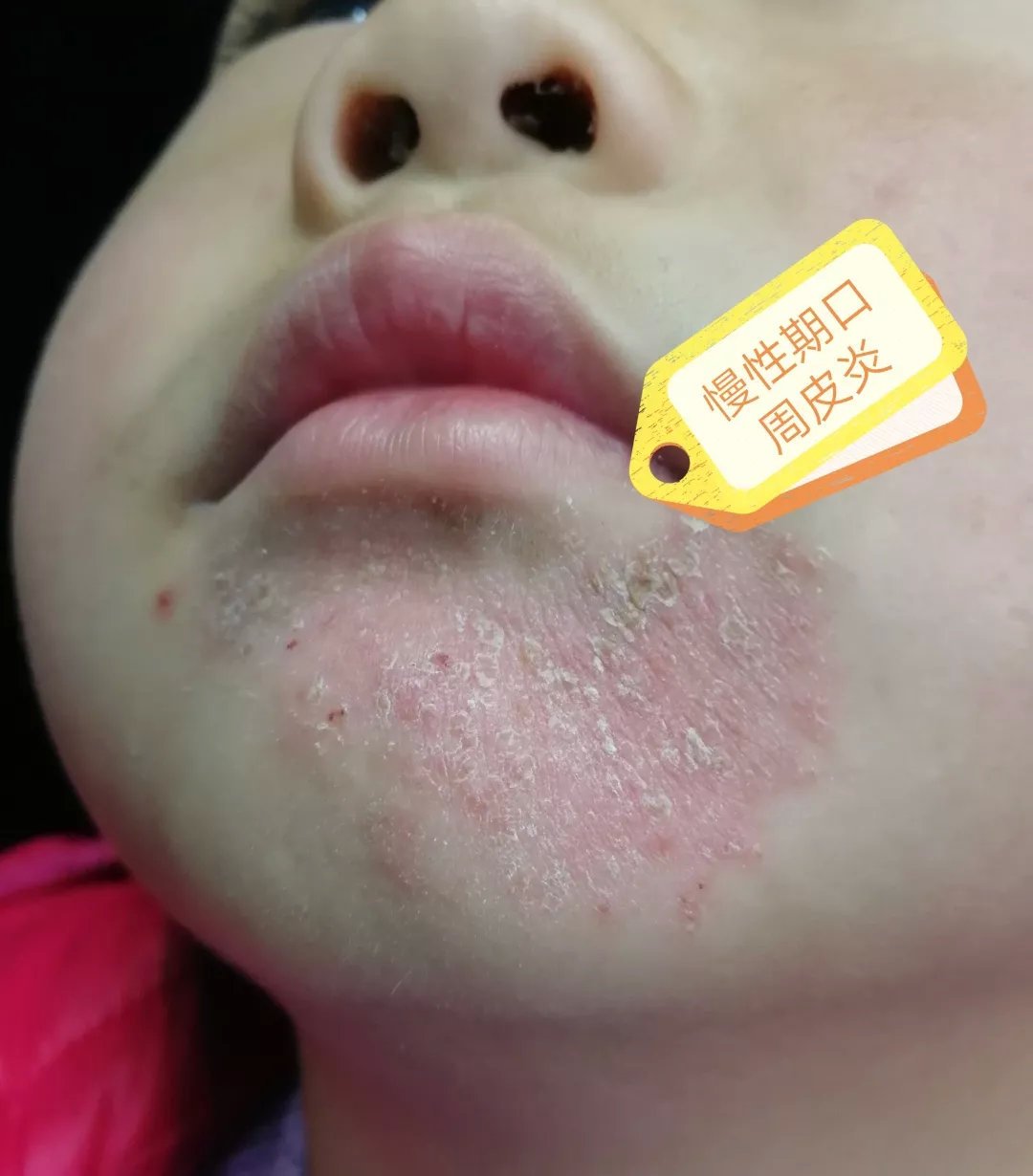 孩子咳嗽嘴角烂怎么办,我家小孩嘴烂了半夜睡觉还哭