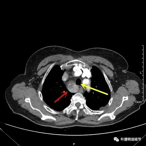 胸部高分辨ct检查注意事项,胸部ct扫描有没有危害
