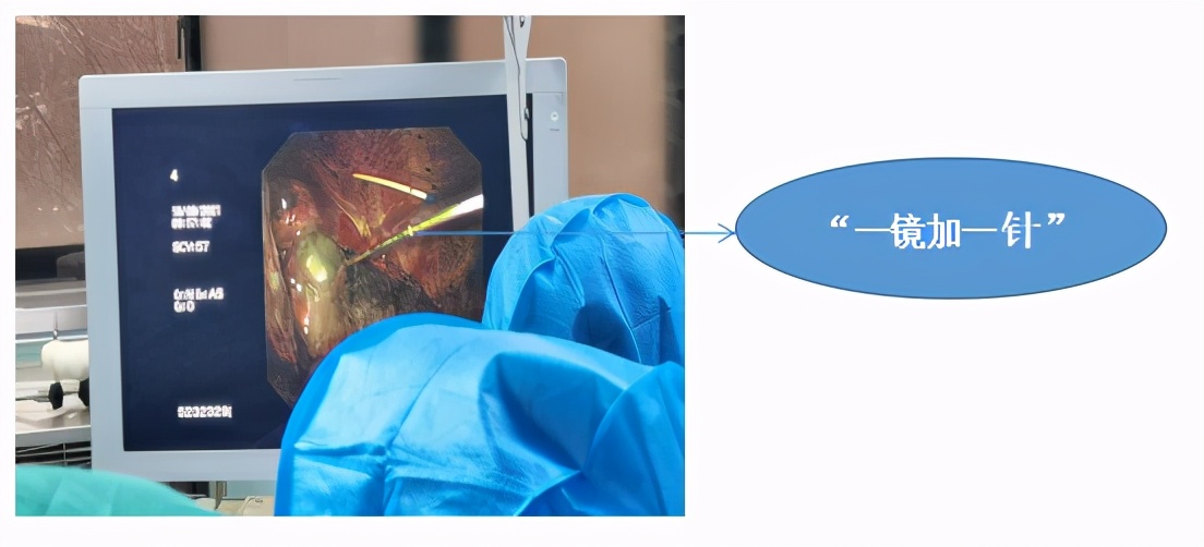 中国第一例肺移植病人,哪个医院能肺移植