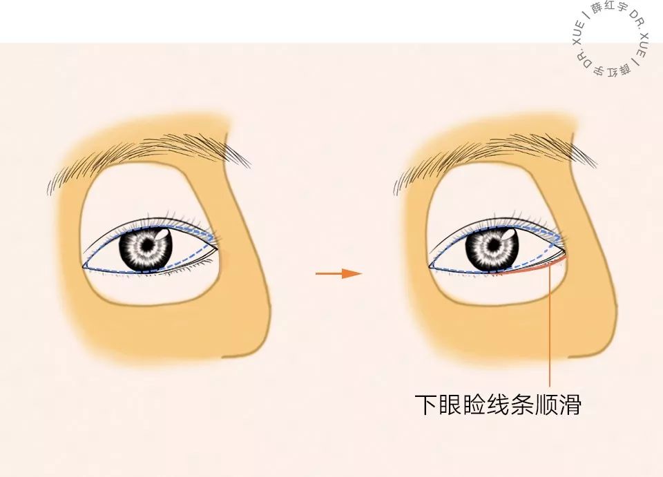 要不要开下眼睑,要不要开内眦赘皮