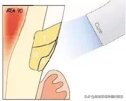 改变刷牙方式楔状缺损就会停止吗,刷牙导致楔状缺损牙齿会断么