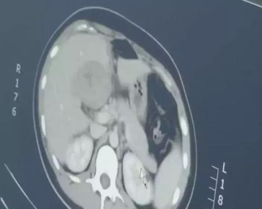 女子怀孕3个月，子宫却是空的！连见多识广的医生都吓坏了！